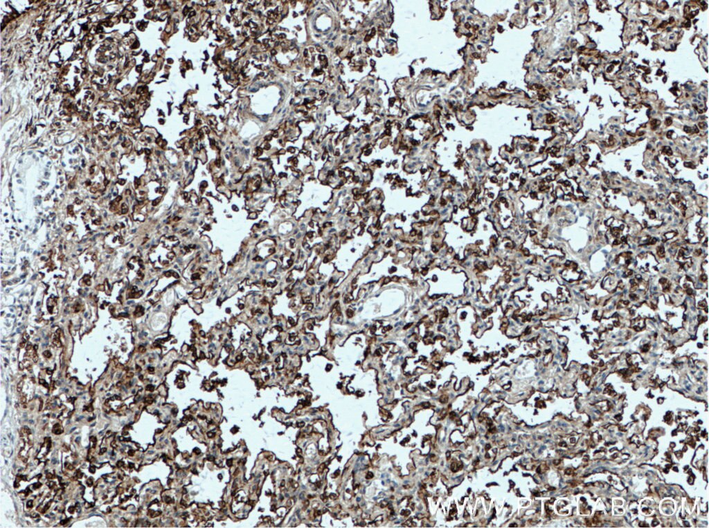 Immunohistochemistry (IHC) staining of human lung tissue using Surfactant Protein A Polyclonal antibody (11850-1-AP)