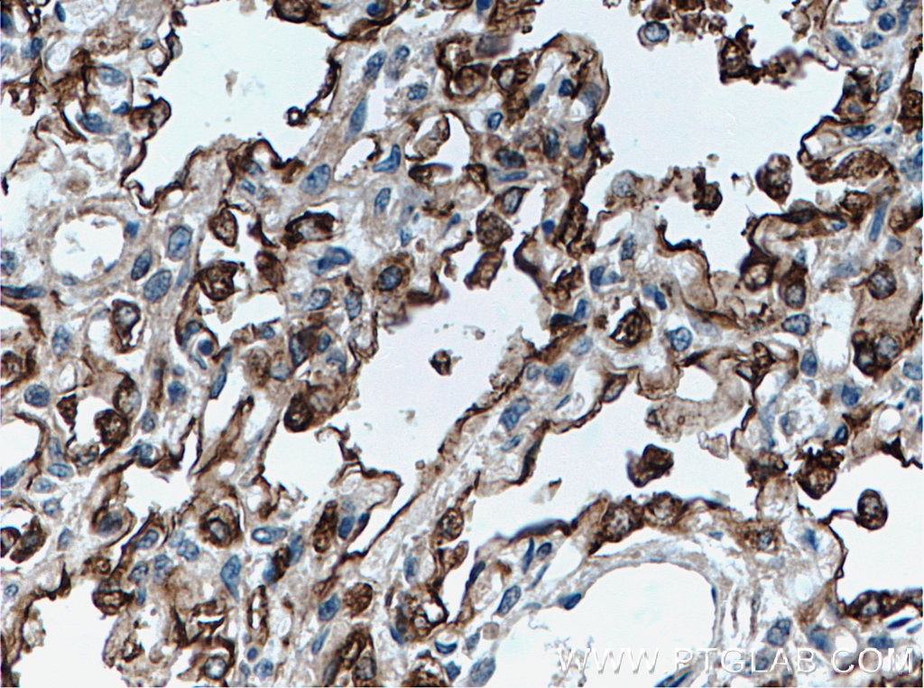 Immunohistochemistry (IHC) staining of human lung tissue using Surfactant Protein A Polyclonal antibody (11850-1-AP)