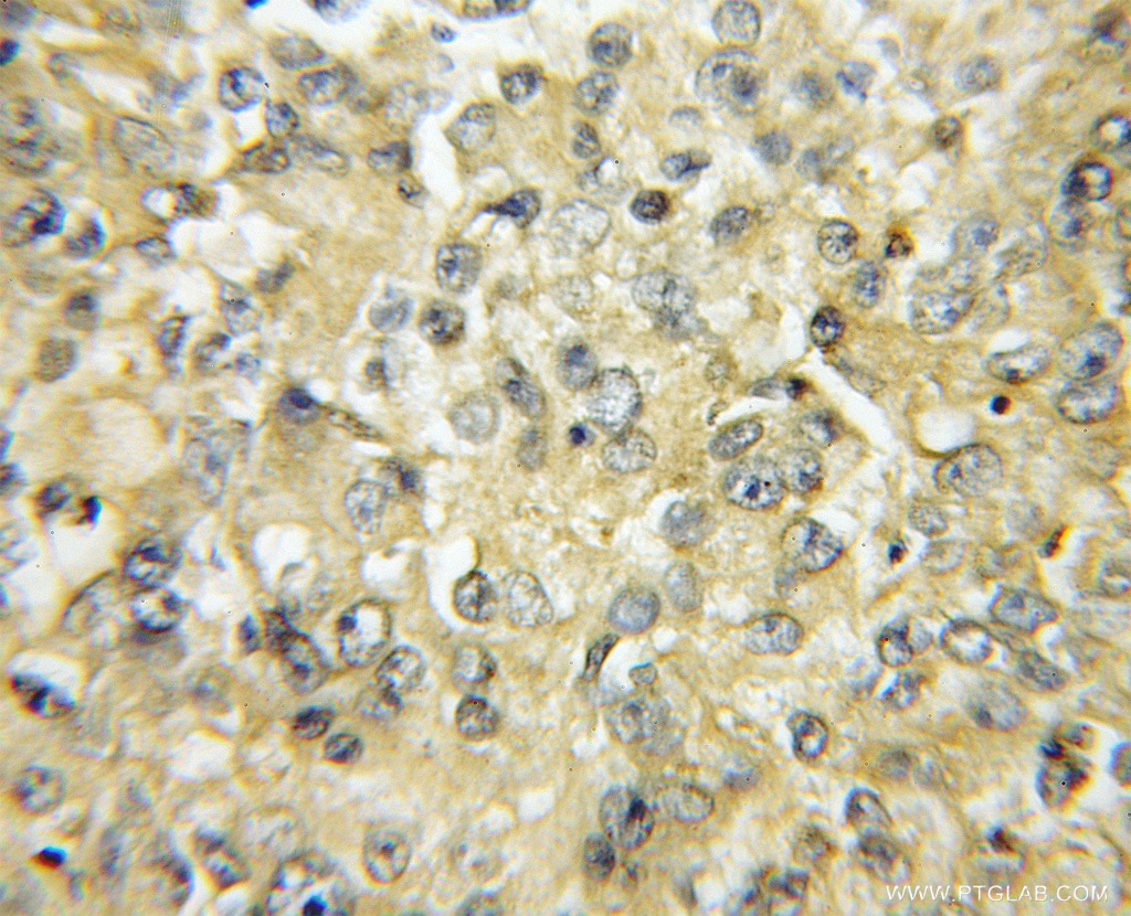 Immunohistochemistry (IHC) staining of human lung cancer tissue using Surfactant Protein A Polyclonal antibody (11850-1-AP)