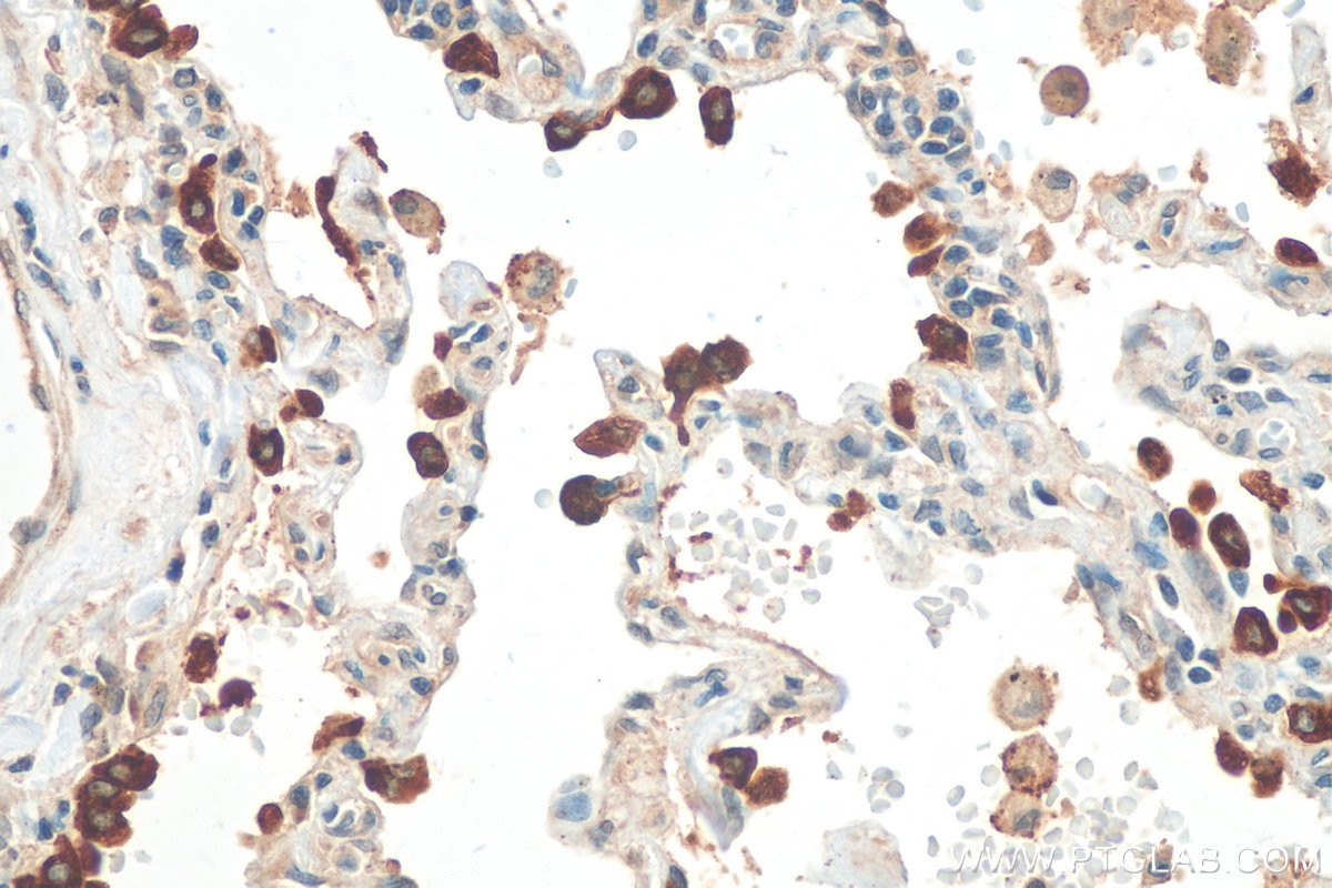 Immunohistochemistry (IHC) staining of human lung tissue using SFTPC Polyclonal antibody (10774-1-AP)