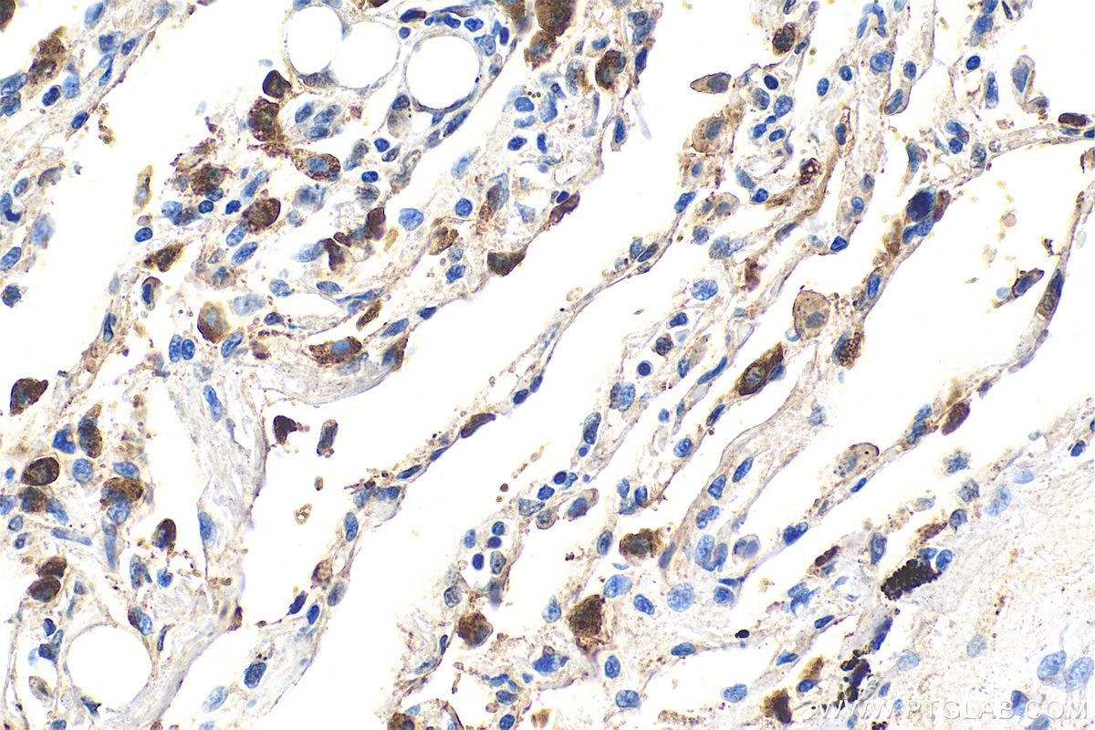 Immunohistochemistry (IHC) staining of human lung tissue using SFTPC Polyclonal antibody (10774-1-AP)