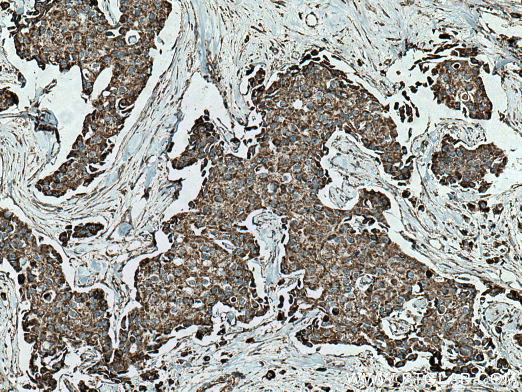 Immunohistochemistry (IHC) staining of human breast cancer tissue using SFXN1 Polyclonal antibody (12296-1-AP)