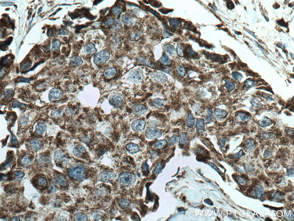 Immunohistochemistry (IHC) staining of human breast cancer tissue using SFXN1 Polyclonal antibody (12296-1-AP)