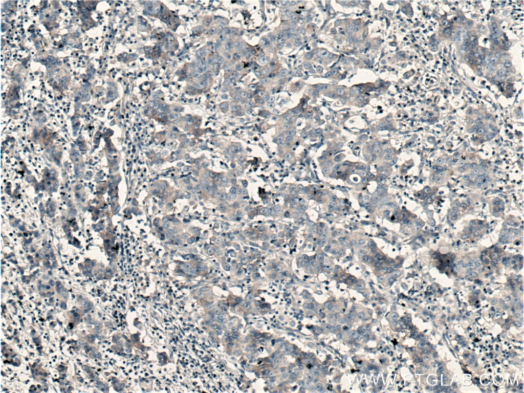 Immunohistochemistry (IHC) staining of human prostate cancer tissue using SGEF Polyclonal antibody (12493-1-AP)