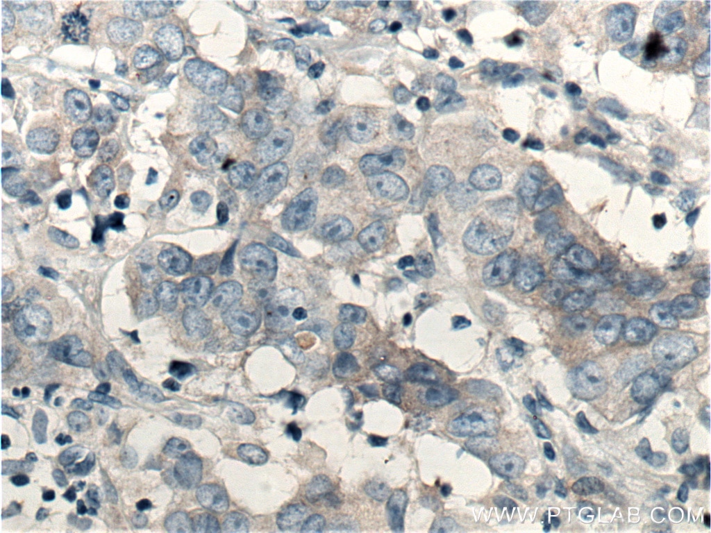 Immunohistochemistry (IHC) staining of human prostate cancer tissue using SGEF Polyclonal antibody (12493-1-AP)