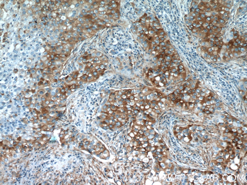 Immunohistochemistry (IHC) staining of human breast cancer tissue using SGK1 Polyclonal antibody (23394-1-AP)