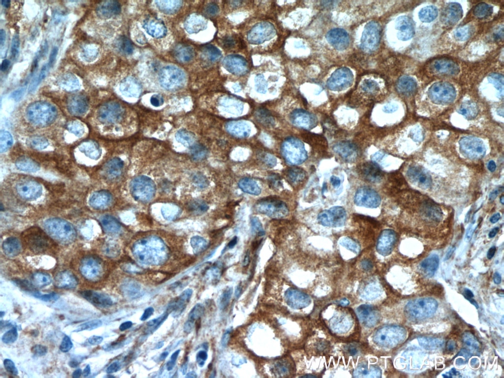 Immunohistochemistry (IHC) staining of human breast cancer tissue using SGK1 Polyclonal antibody (23394-1-AP)