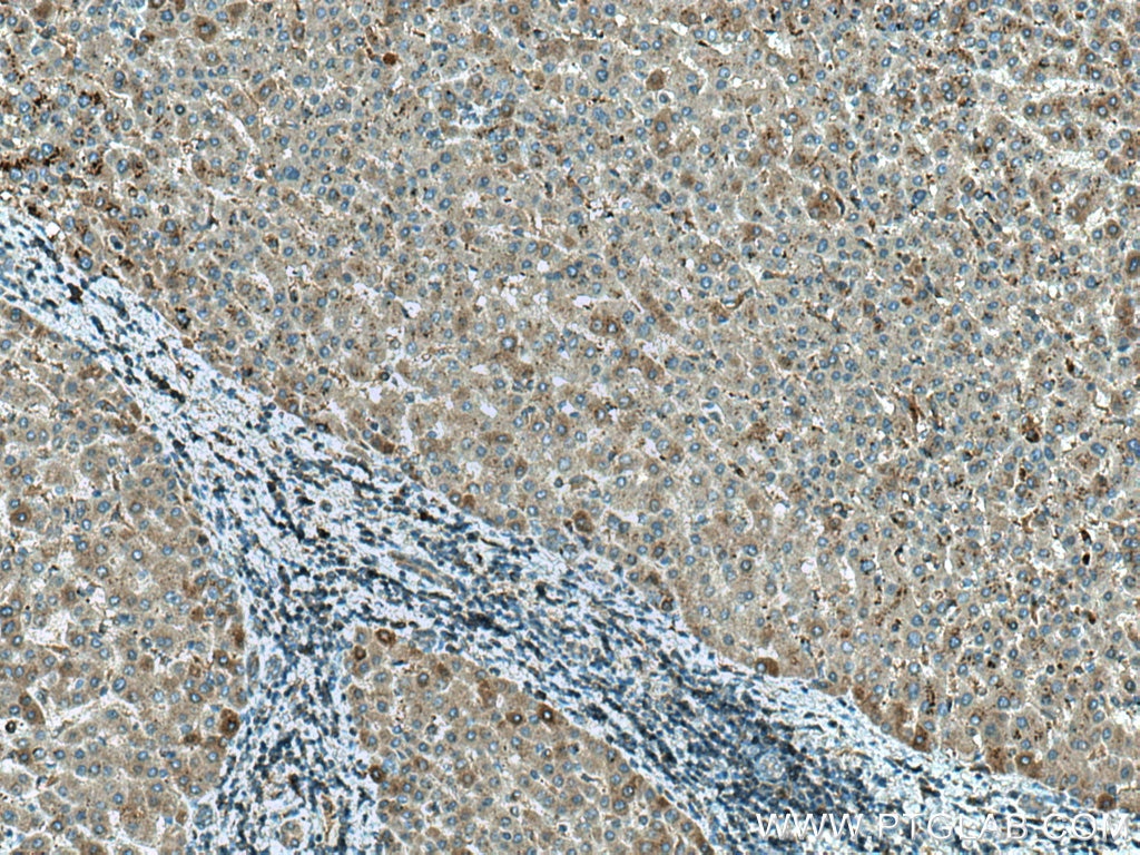 Immunohistochemistry (IHC) staining of human liver cancer tissue using SGK1 Polyclonal antibody (28454-1-AP)