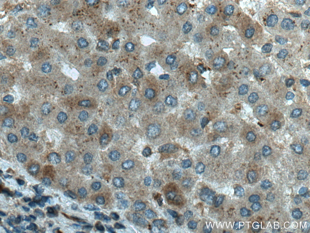 Immunohistochemistry (IHC) staining of human liver cancer tissue using SGK1 Polyclonal antibody (28454-1-AP)