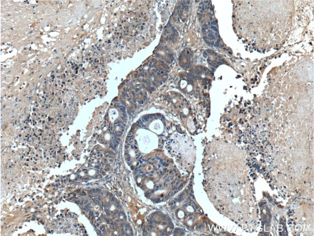 Immunohistochemistry (IHC) staining of human pancreas cancer tissue using SGK2 Polyclonal antibody (11185-1-AP)