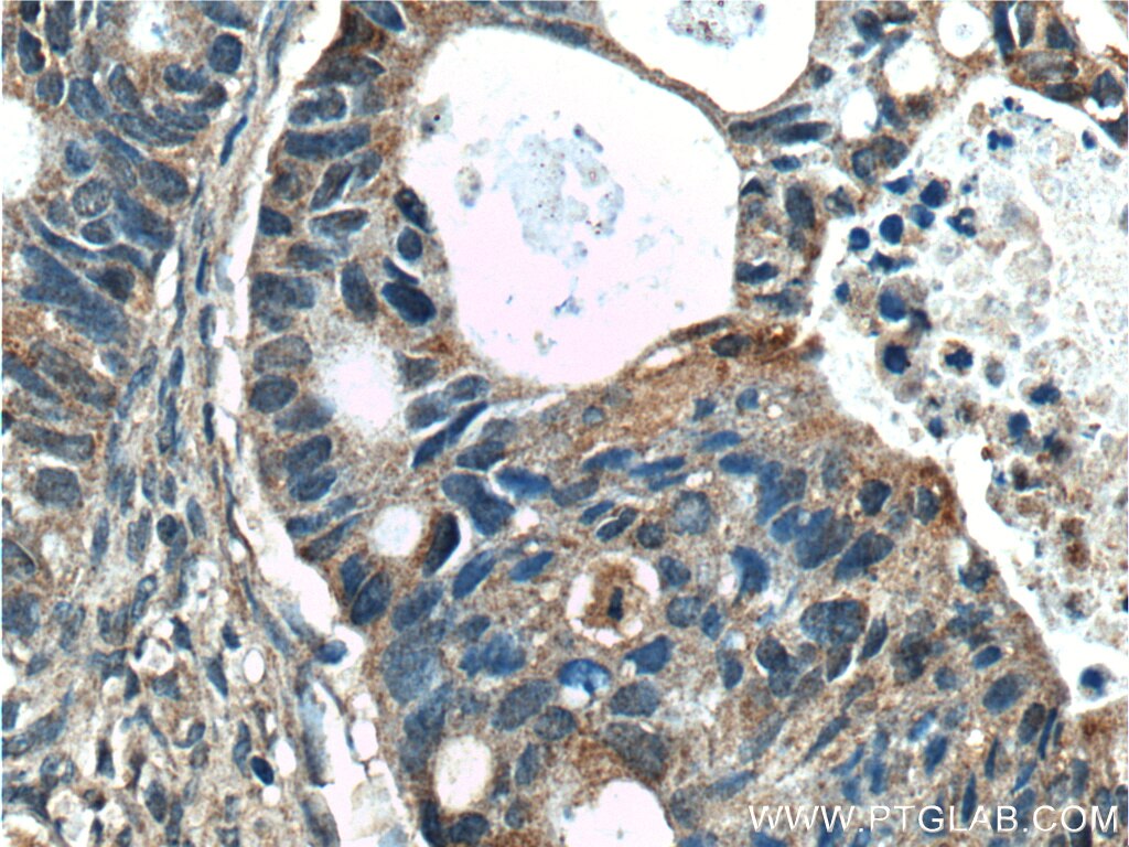 Immunohistochemistry (IHC) staining of human pancreas cancer tissue using SGK2 Polyclonal antibody (11185-1-AP)