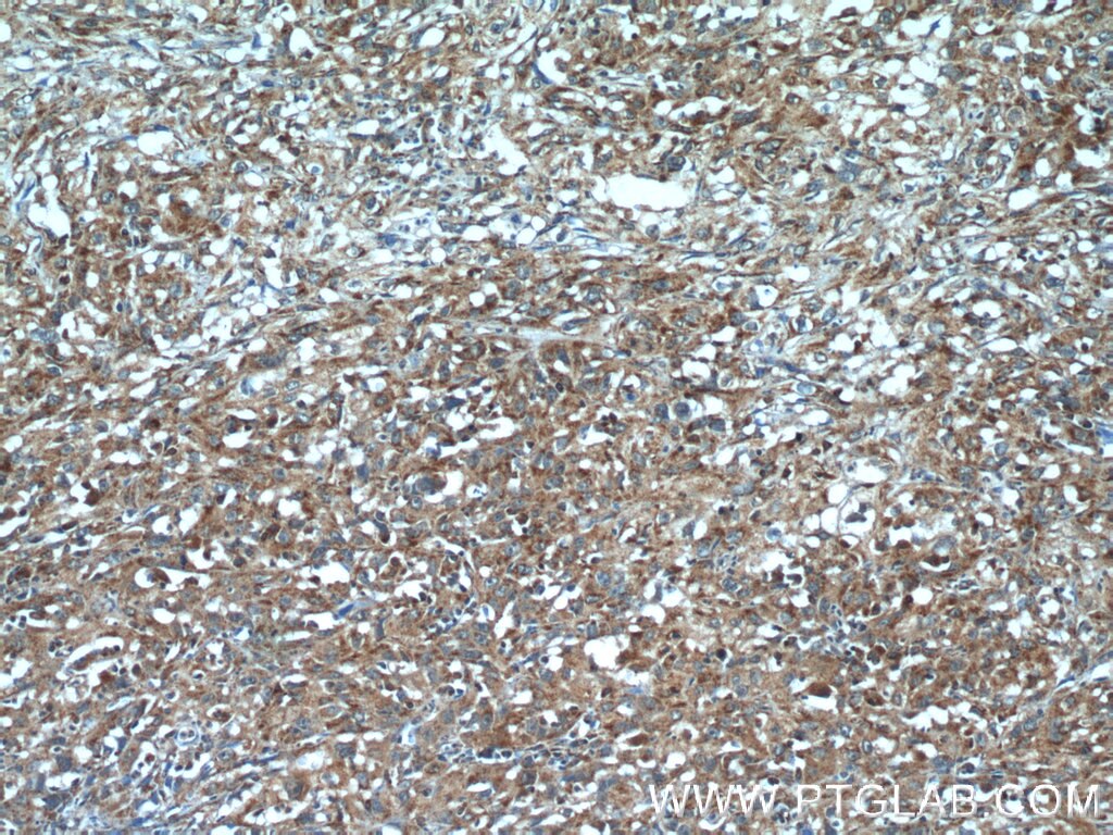 Immunohistochemistry (IHC) staining of human cervical cancer tissue using SGK3 Polyclonal antibody (12699-1-AP)