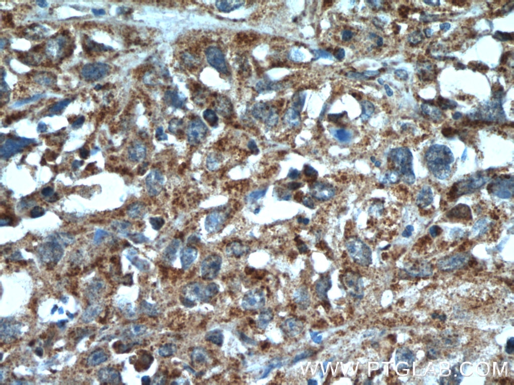 Immunohistochemistry (IHC) staining of human cervical cancer tissue using SGK3 Polyclonal antibody (12699-1-AP)