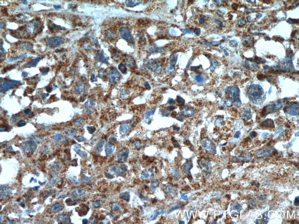 Immunohistochemistry (IHC) staining of human cervical cancer tissue using SGK3 Polyclonal antibody (12699-1-AP)