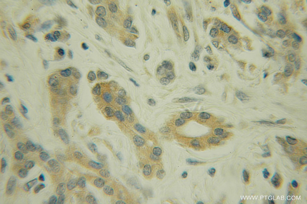 Immunohistochemistry (IHC) staining of human pancreas cancer tissue using SGK3 Polyclonal antibody (12699-1-AP)
