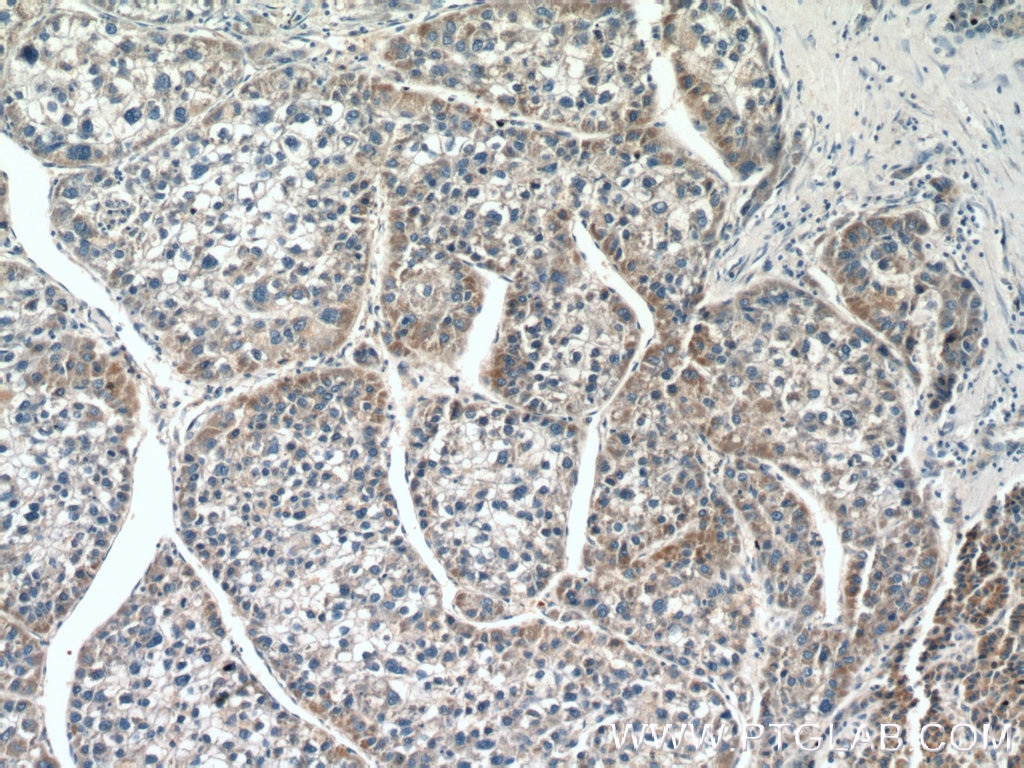 Immunohistochemistry (IHC) staining of human liver cancer tissue using SGK3 Polyclonal antibody (22100-1-AP)