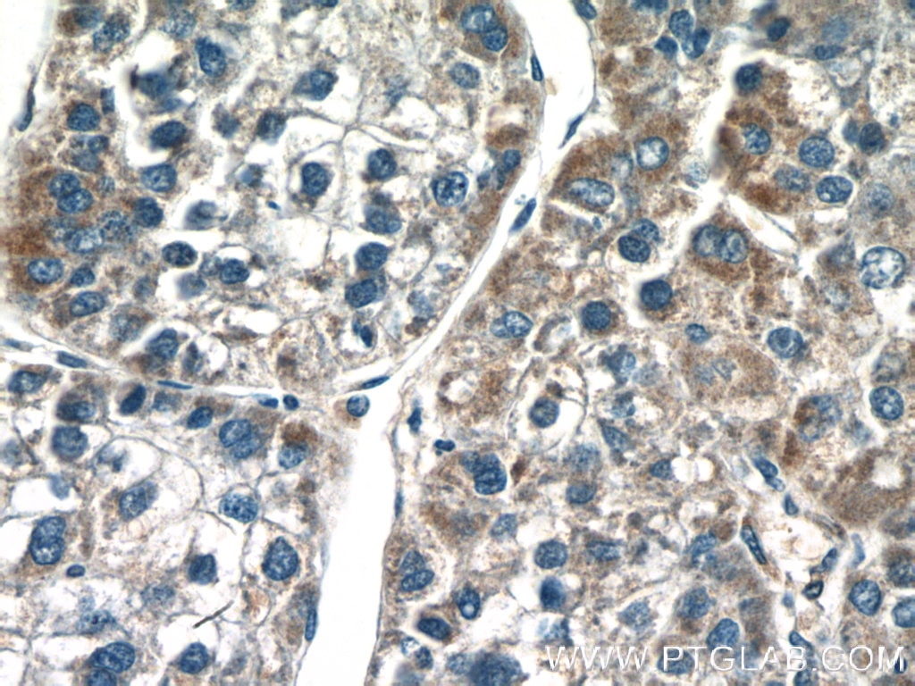 Immunohistochemistry (IHC) staining of human liver cancer tissue using SGK3 Polyclonal antibody (22100-1-AP)