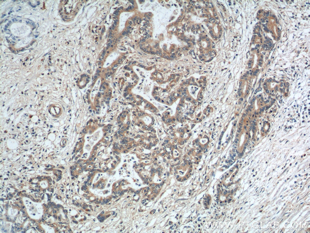 Immunohistochemistry (IHC) staining of human pancreas cancer tissue using SGSH Polyclonal antibody (14184-1-AP)