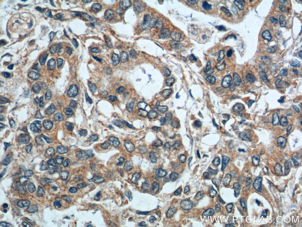 Immunohistochemistry (IHC) staining of human pancreas cancer tissue using SGSH Polyclonal antibody (14184-1-AP)