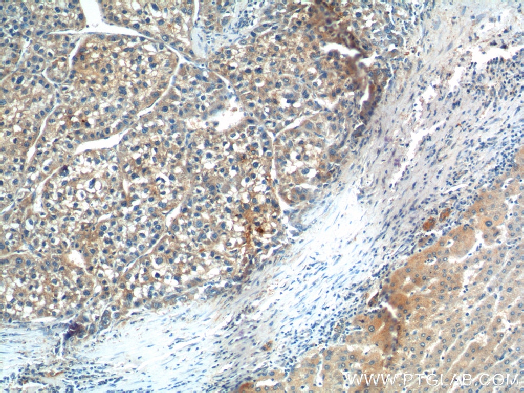 Immunohistochemistry (IHC) staining of human liver cancer tissue using SGSH Polyclonal antibody (14184-1-AP)