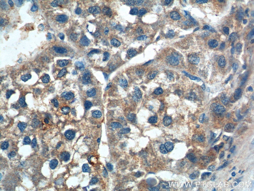 Immunohistochemistry (IHC) staining of human liver cancer tissue using SGSH Polyclonal antibody (14184-1-AP)
