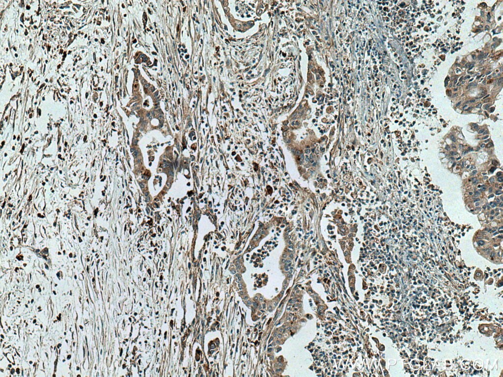 Immunohistochemistry (IHC) staining of human pancreas cancer tissue using SGSH Polyclonal antibody (28150-1-AP)