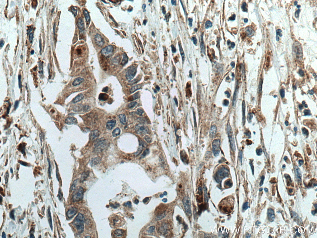 IHC staining of human pancreas cancer using 28150-1-AP