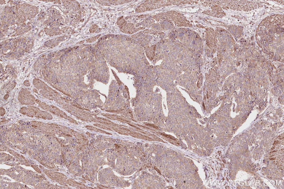 Immunohistochemistry (IHC) staining of human stomach cancer tissue using SGSM3 Polyclonal antibody (20825-1-AP)