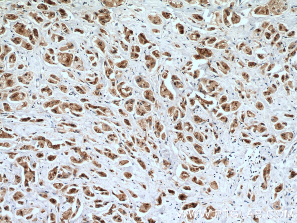 Immunohistochemistry (IHC) staining of human breast cancer tissue using SGSM3 Polyclonal antibody (27147-1-AP)