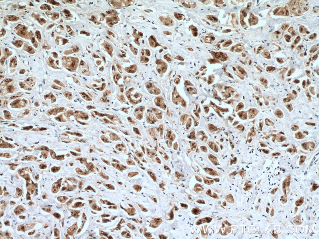 Immunohistochemistry (IHC) staining of human breast cancer tissue using SGSM3 Polyclonal antibody (27147-1-AP)