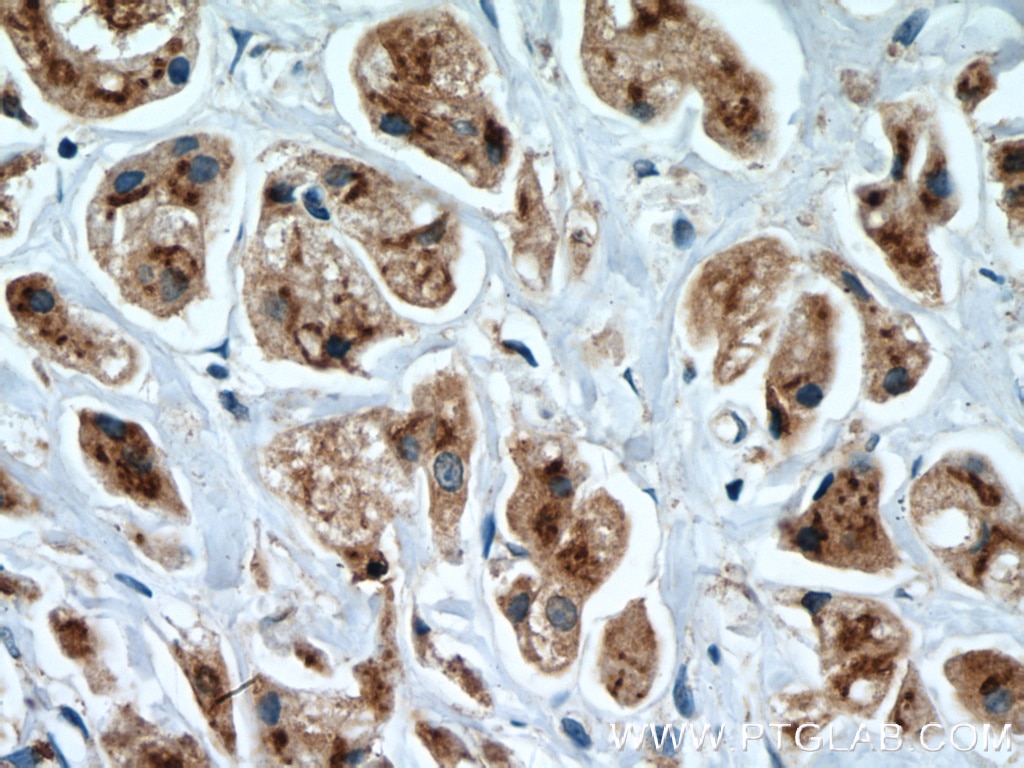 Immunohistochemistry (IHC) staining of human breast cancer tissue using SGSM3 Polyclonal antibody (27147-1-AP)
