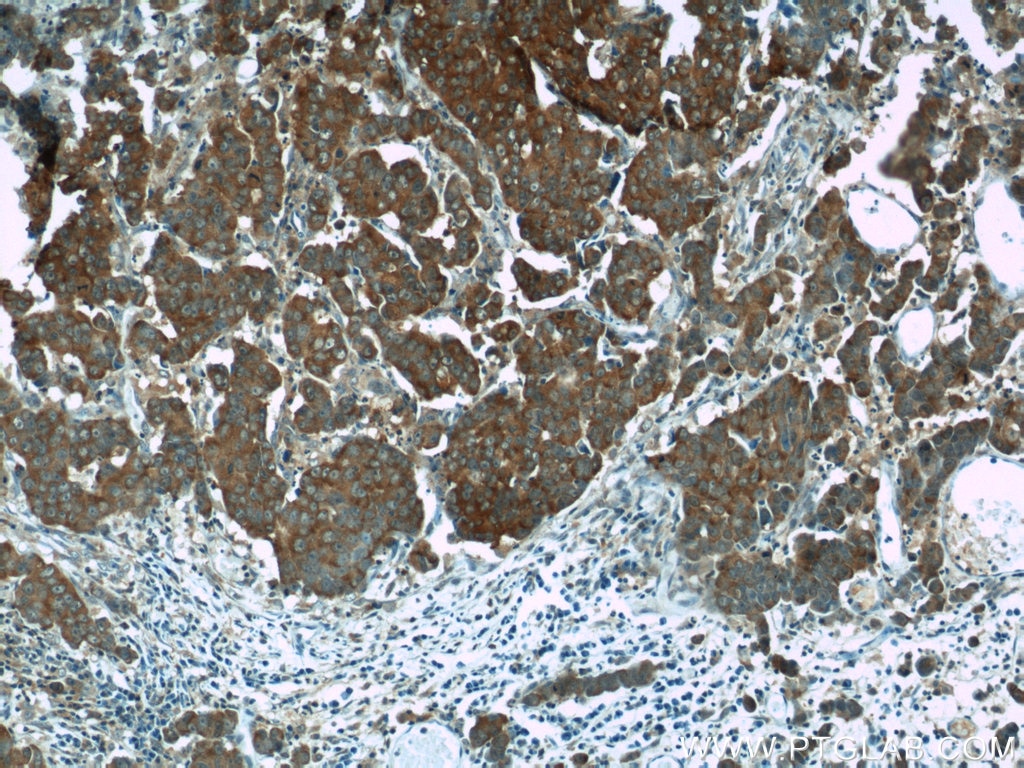 Immunohistochemistry (IHC) staining of human prostate cancer tissue using SGTA Polyclonal antibody (11019-2-AP)