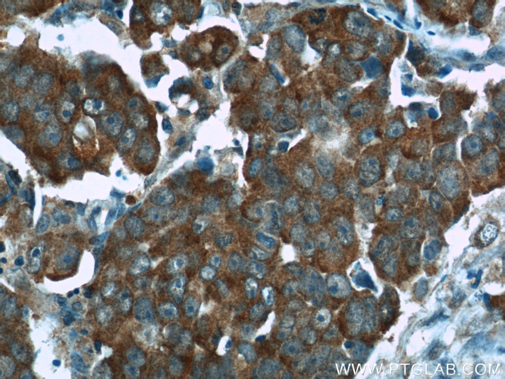 Immunohistochemistry (IHC) staining of human prostate cancer tissue using SGTA Polyclonal antibody (11019-2-AP)