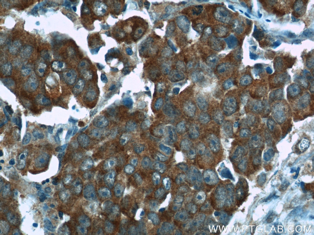 IHC staining of human prostate cancer using 11019-2-AP