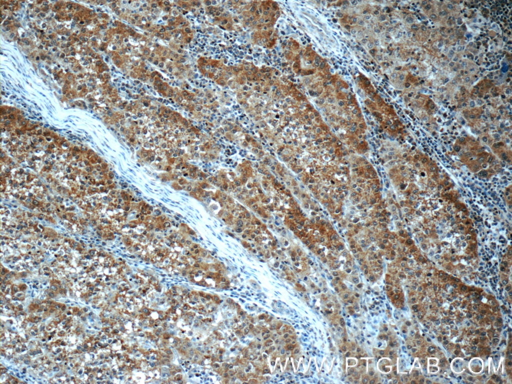 Immunohistochemistry (IHC) staining of human liver cancer tissue using SGTA Polyclonal antibody (11019-2-AP)