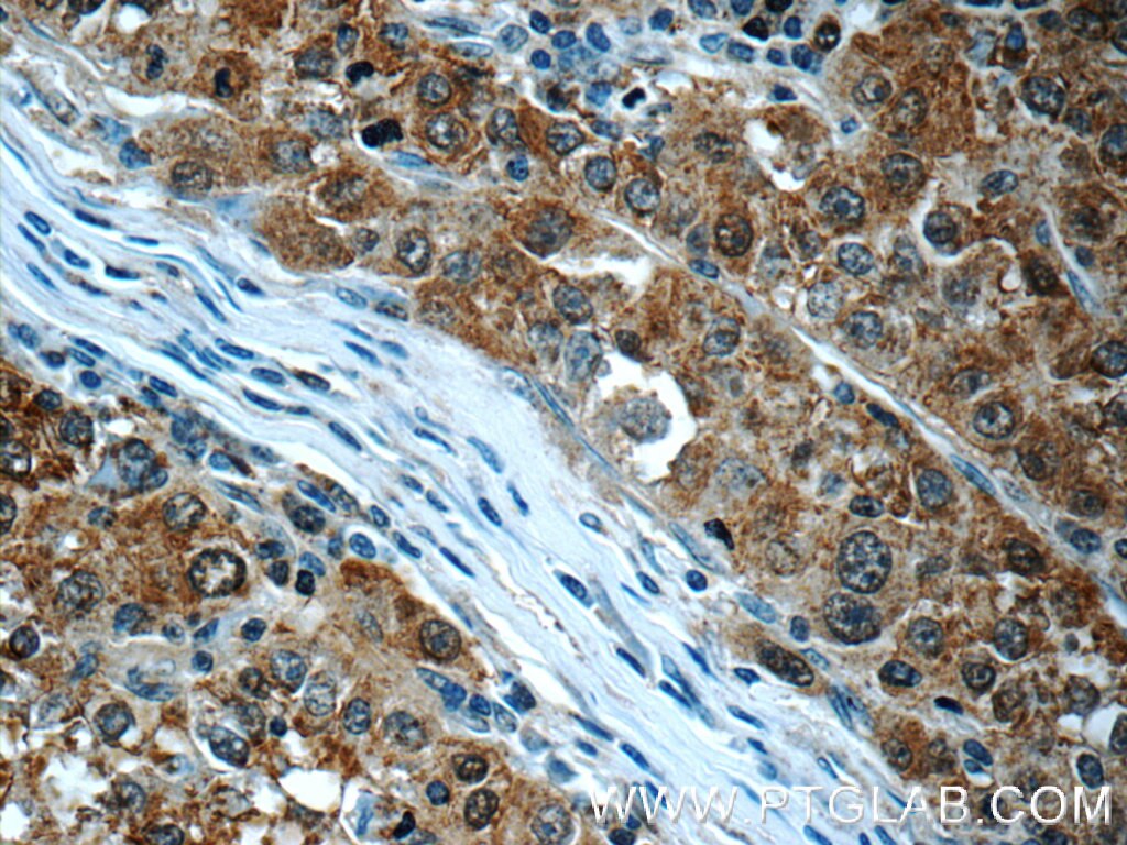 Immunohistochemistry (IHC) staining of human liver cancer tissue using SGTA Polyclonal antibody (11019-2-AP)