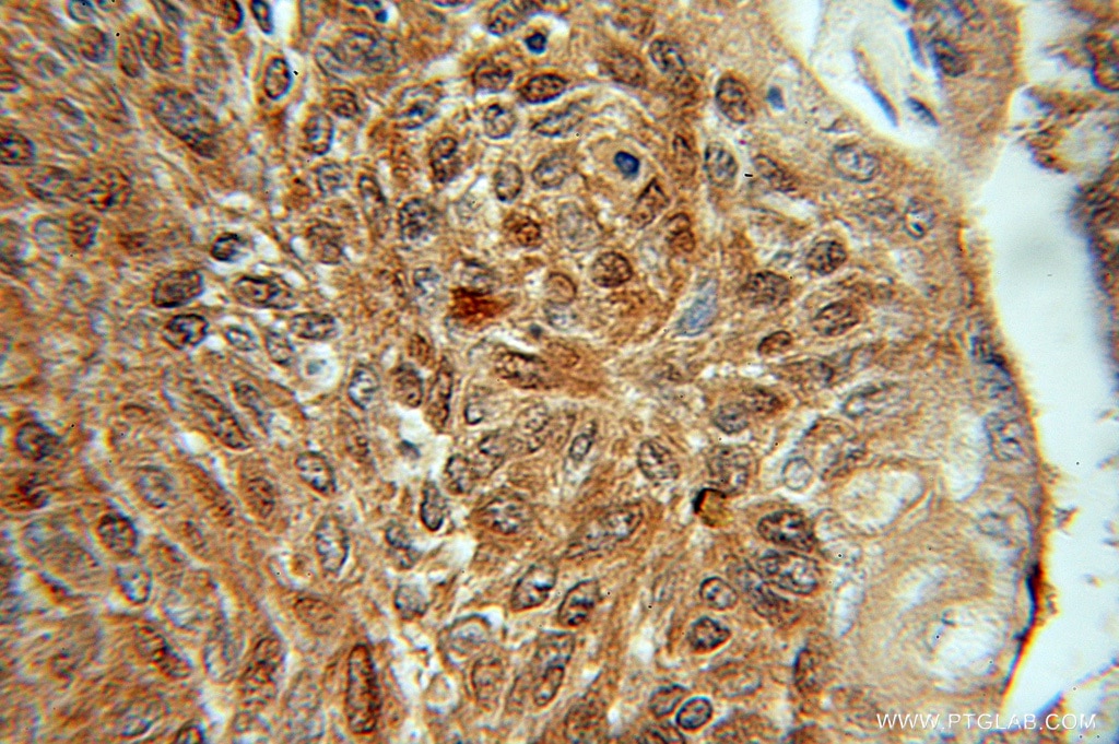 Immunohistochemistry (IHC) staining of human lung cancer tissue using SGTA Polyclonal antibody (11019-2-AP)