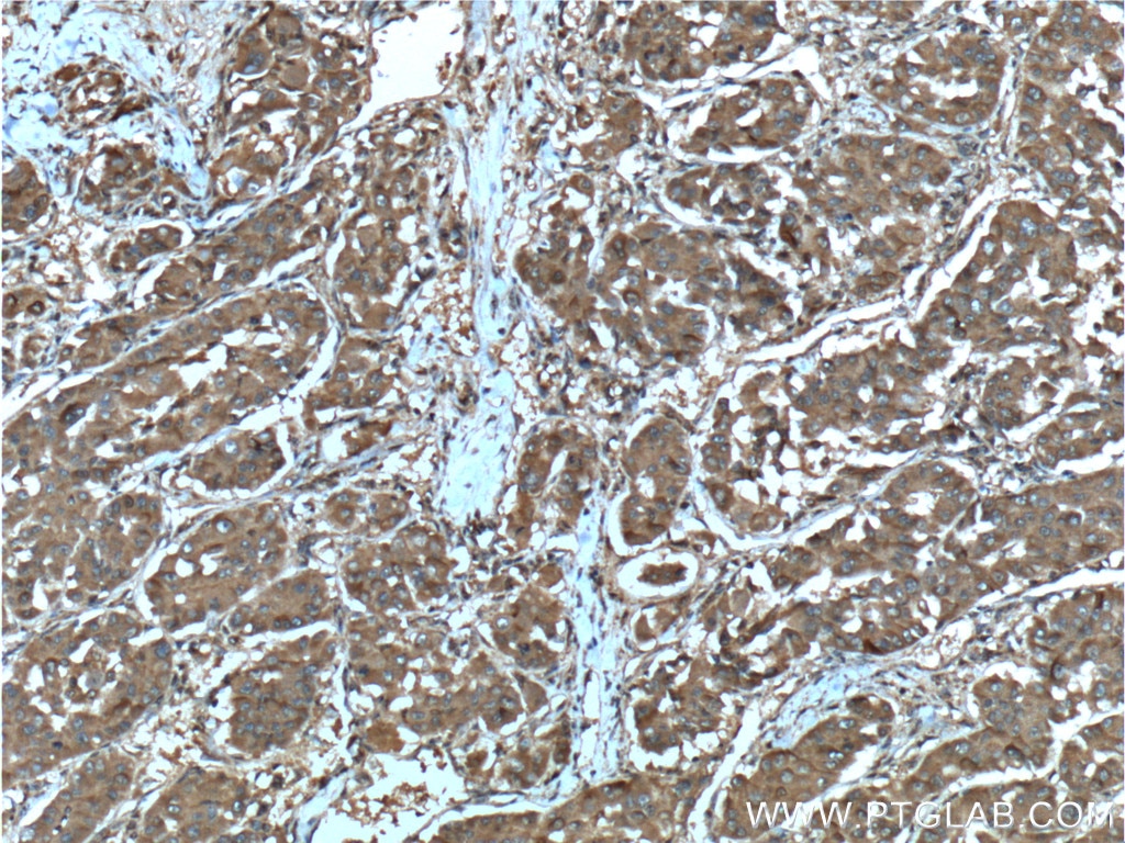 Immunohistochemistry (IHC) staining of human liver cancer tissue using SGTA Monoclonal antibody (60305-1-Ig)
