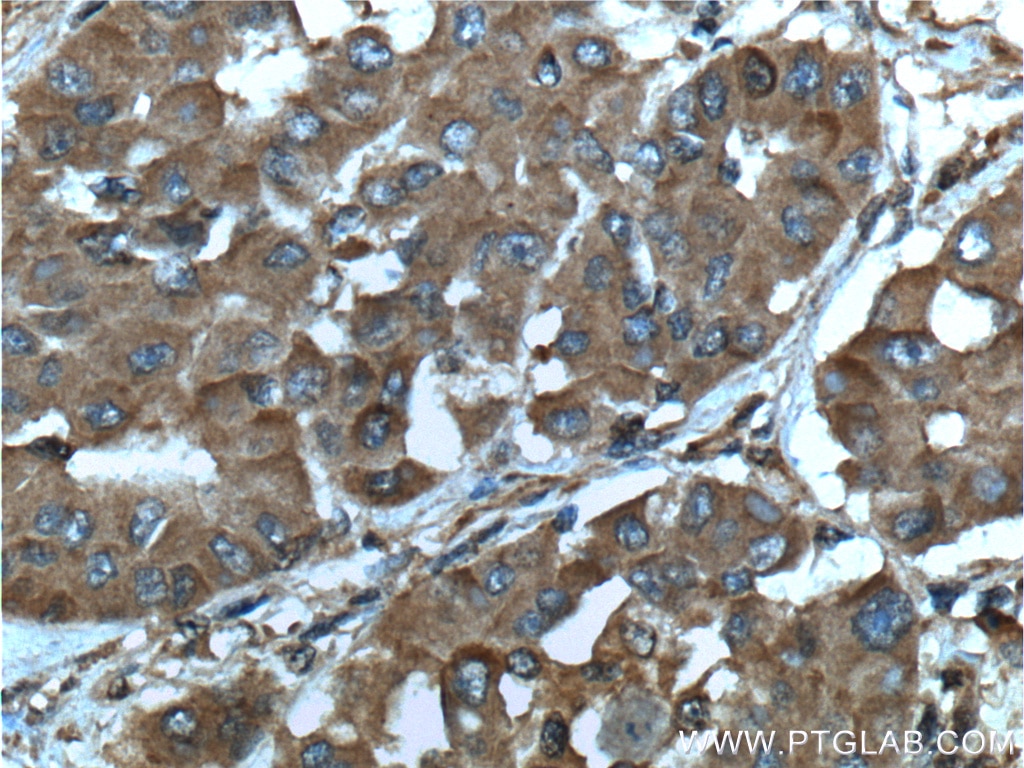 Immunohistochemistry (IHC) staining of human liver cancer tissue using SGTA Monoclonal antibody (60305-1-Ig)