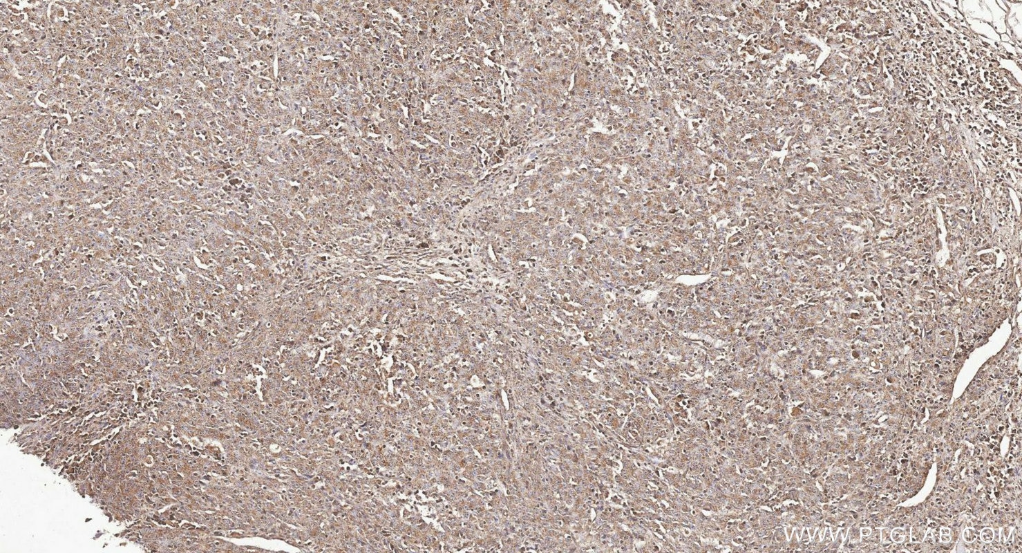 IHC staining of human lymphoma using 22198-1-AP Immunohistochemistry (IHC) staining of human lymphoma tissue using SH2B3 Polyclonal antibody (22198-1-AP)