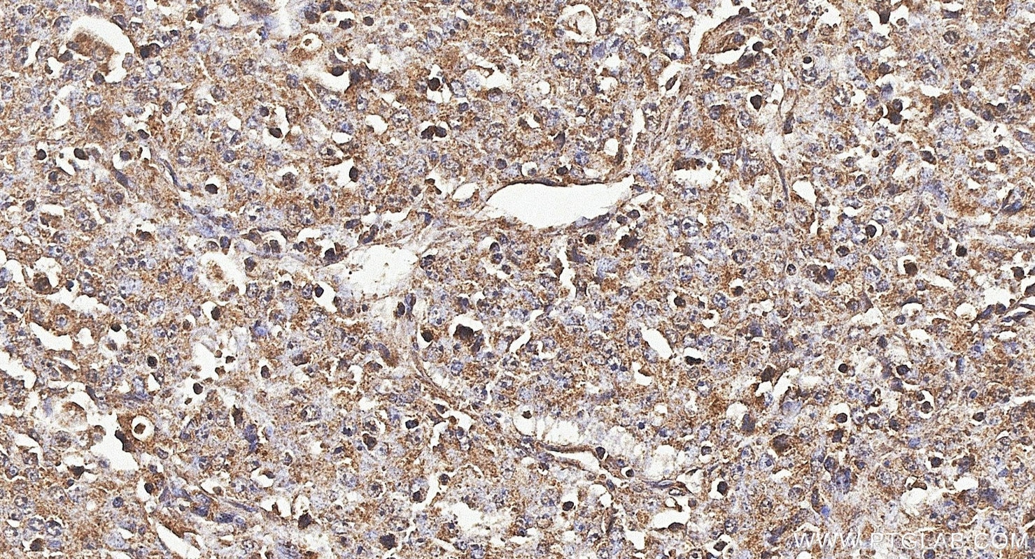 IHC staining of human lymphoma using 22198-1-AP Immunohistochemistry (IHC) staining of human lymphoma tissue using SH2B3 Polyclonal antibody (22198-1-AP)