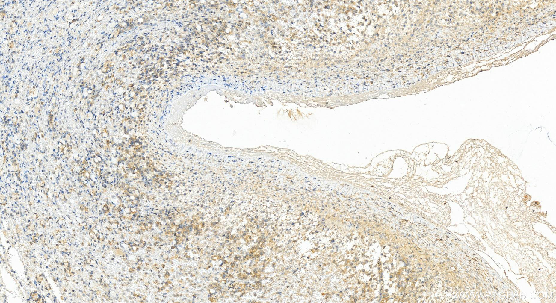 Immunohistochemistry (IHC) staining of human ovary cancer tissue using SH2D3A Polyclonal antibody (15641-1-AP)