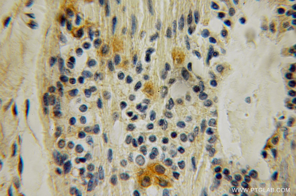 Immunohistochemistry (IHC) staining of human breast cancer tissue using SH2D3C Polyclonal antibody (12882-1-AP)