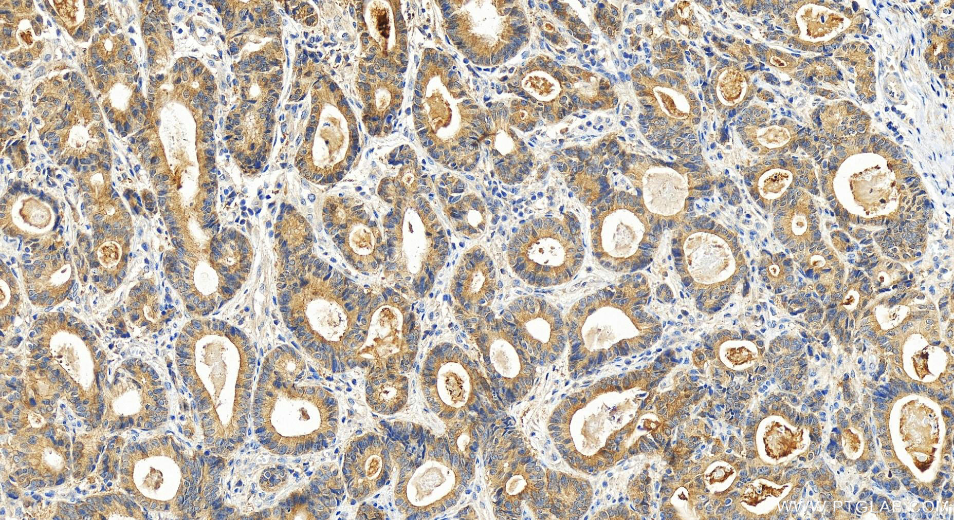 Immunohistochemistry (IHC) staining of human stomach cancer tissue using SH2D4A Polyclonal antibody (15957-1-AP)