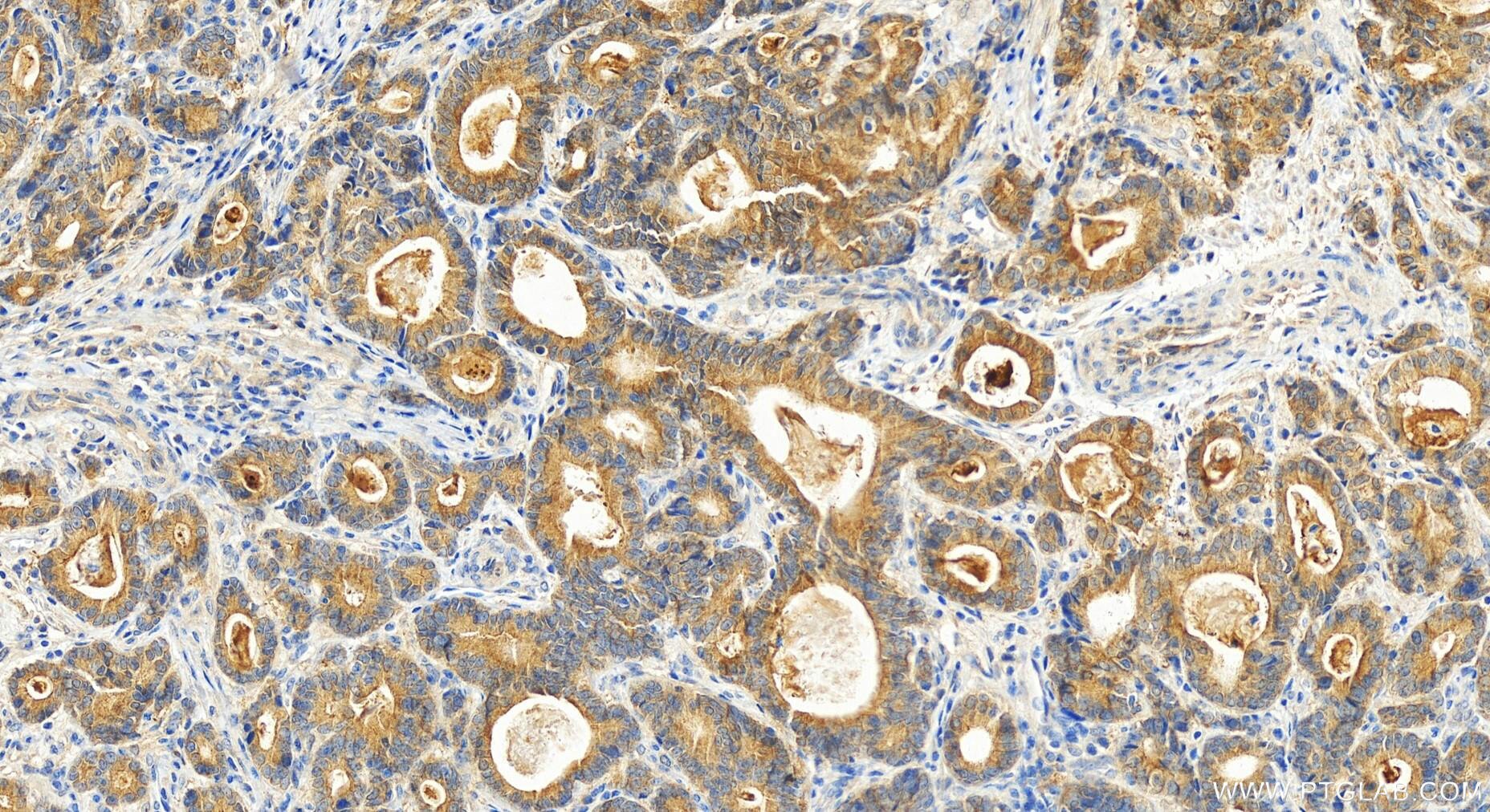 Immunohistochemistry (IHC) staining of human stomach cancer tissue using SH2D4A Polyclonal antibody (15957-1-AP)