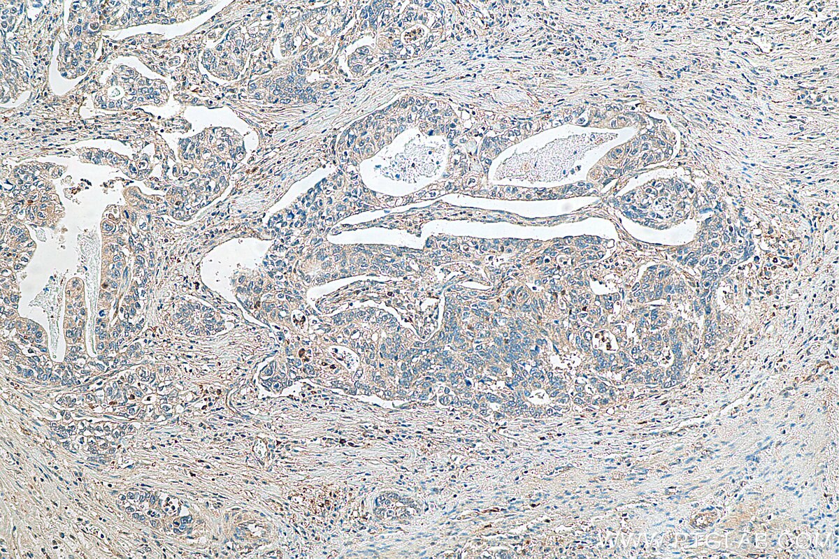 Immunohistochemistry (IHC) staining of human stomach cancer tissue using SH3BGRL3 Polyclonal antibody (12210-1-AP)