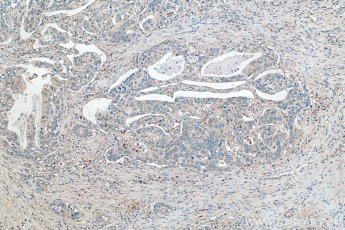 IHC staining of human stomach cancer using 12210-1-AP