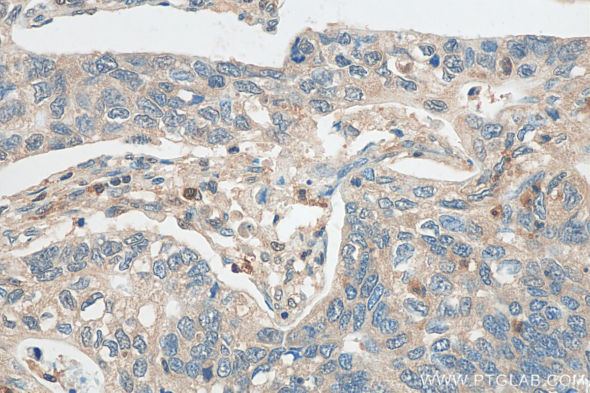 Immunohistochemistry (IHC) staining of human stomach cancer tissue using SH3BGRL3 Polyclonal antibody (12210-1-AP)