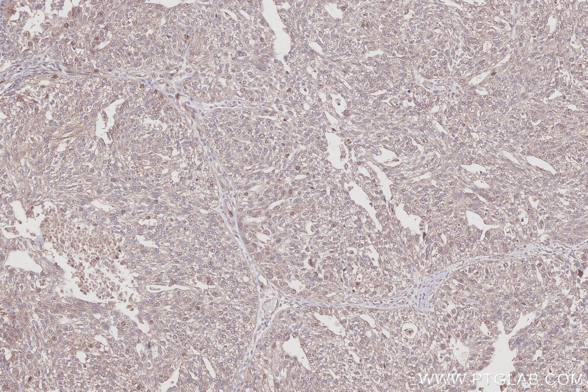 IHC staining of human ovary cancer using 68045-1-Ig Immunohistochemistry (IHC) staining of human ovary cancer tissue using SH3BP4 Monoclonal antibody (68045-1-Ig)