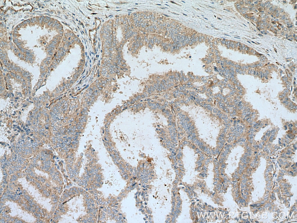 Immunohistochemistry (IHC) staining of human ovary tumor tissue using SH3BP5 Polyclonal antibody (11127-2-AP)